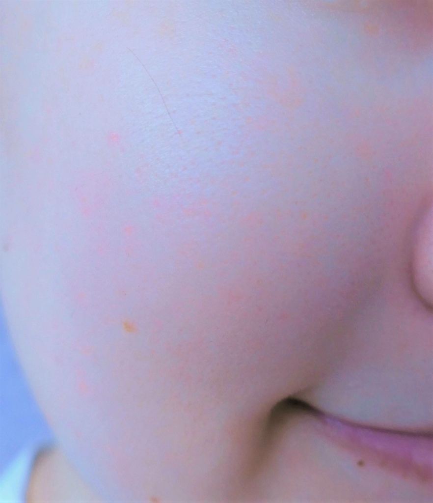 瑪西隨筆拍攝個人臉部肌膚特寫，肌膚又薄還帶點泛紅又容易乾癢
