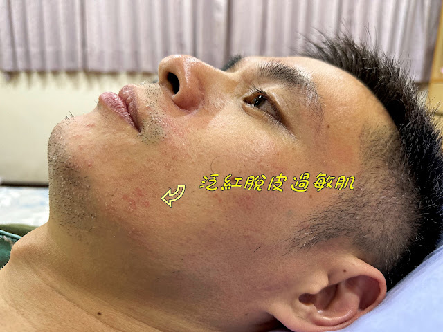 小滿媽咪love親子拍攝小滿媽咪的先生因換季肌膚變的過敏泛紅