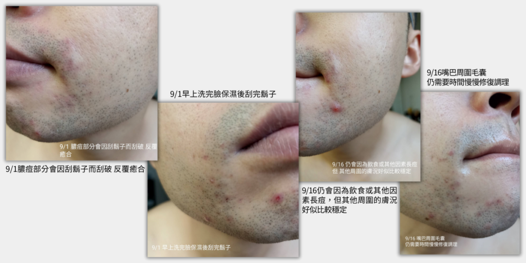 普度痘肌使用者體驗陳先生使用薇霓肌本粉刺痘痘調理組的前後比較照片