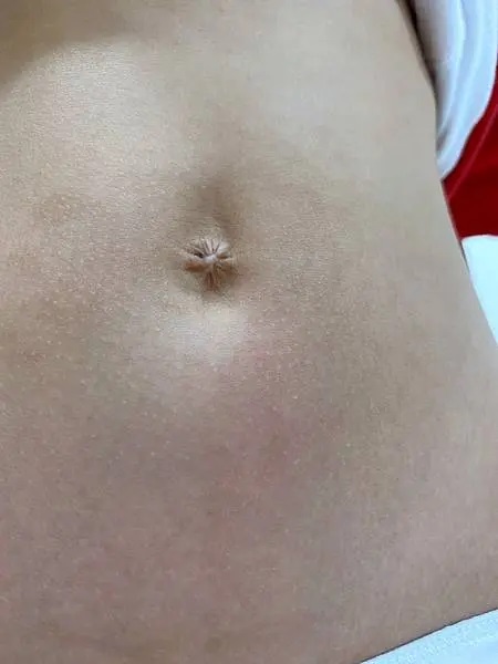 這是一張肚臍的特寫照片，細緻地展示了其形狀和周圍的皮膚狀況。