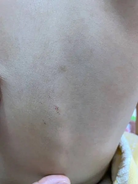 這是一張上背部的特寫照片，顯示了皮膚的狀況