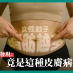 女性身穿裸色短上衣與黑色內褲，雙手指向腹部兩側，腹部肌膚上透過曬痕形成「女性肚子 脂肪越多」字樣，搭配下方強調文字「研究發現：竟是這種皮膚病症！」，畫面強調肌膚色差與脂肪堆積，傳達可能與健康或皮膚疾病相關的警訊議題。