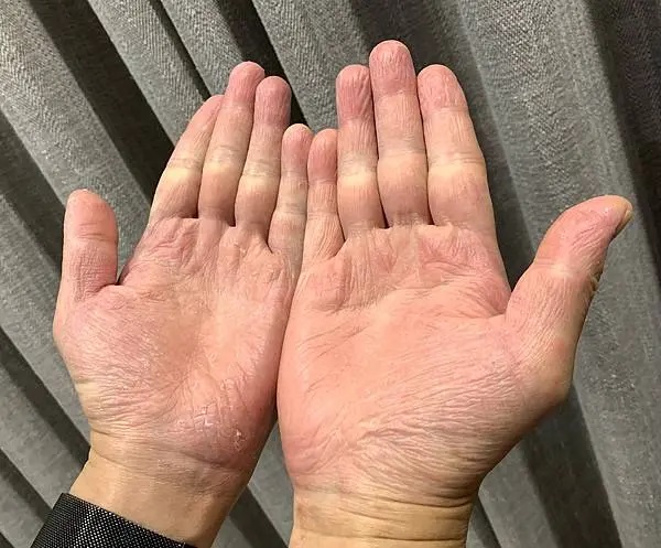 雙手掌心肌膚乾燥脫屑、紋路粗糙明顯，呈現使用薇霓肌本保濕乳霜前的極度乾燥膚況，背景為深灰色窗簾