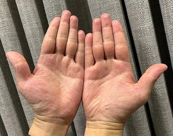 使用薇霓肌本保濕乳霜後雙手膚況穩定，乾裂狀況改善，肌膚柔嫩滑順不再脫屑