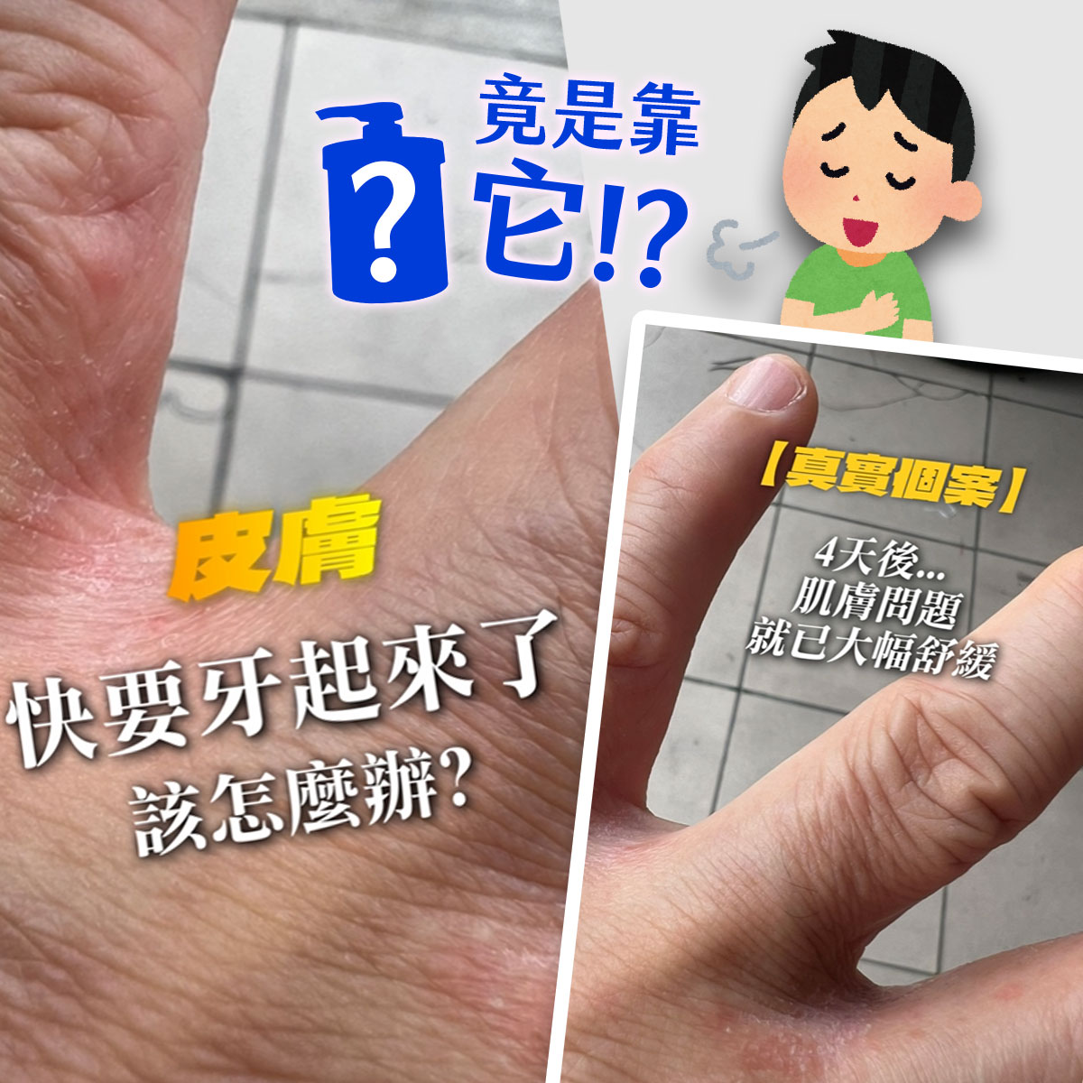 手部皮膚乾裂案例對照圖。左圖為手掌與虎口處乾燥、泛紅、脫皮的特寫,文字寫著『皮膚快要牙起來了,該怎麼辦?』;右圖為同一部位在改善後的狀況,肌膚明顯恢復平滑,搭配文字『真實個案|4天後…肌膚問題就已大幅舒緩』。整體以藍、黃強調字呈現,搭配洗手乳瓶圖示與人物插畫,暗示透過正確保養與溫和產品可有效改善乾裂與粗糙,傳達肌膚修護見證概念。
