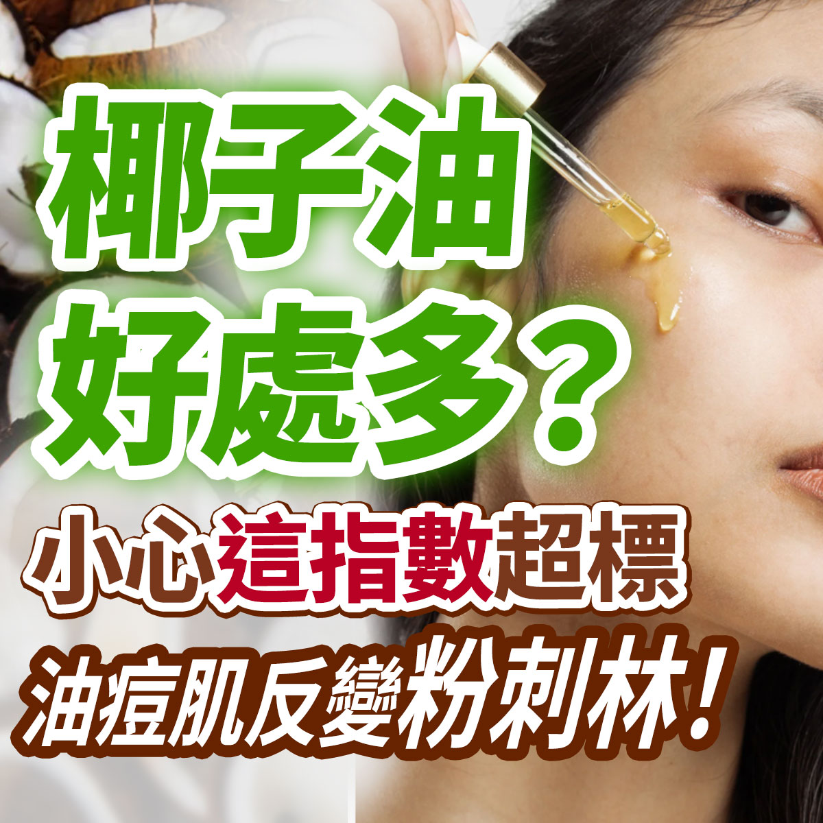 椰子油致粉刺衛教圖。右側女性臉頰正滴下精華油,左側背景為剖開的椰子果肉。畫面印有椰子油好處多?小心這指數超標,油痘肌反變粉刺林等油痘肌毛孔阻塞衛教文案。